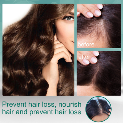 Pelo del crecimiento del tratamiento de la pérdida de pelo del aceite de la esencia del suero del crecimiento del pelo de Ginger Hair Growth Essence Germinal para las mujeres de los hombres